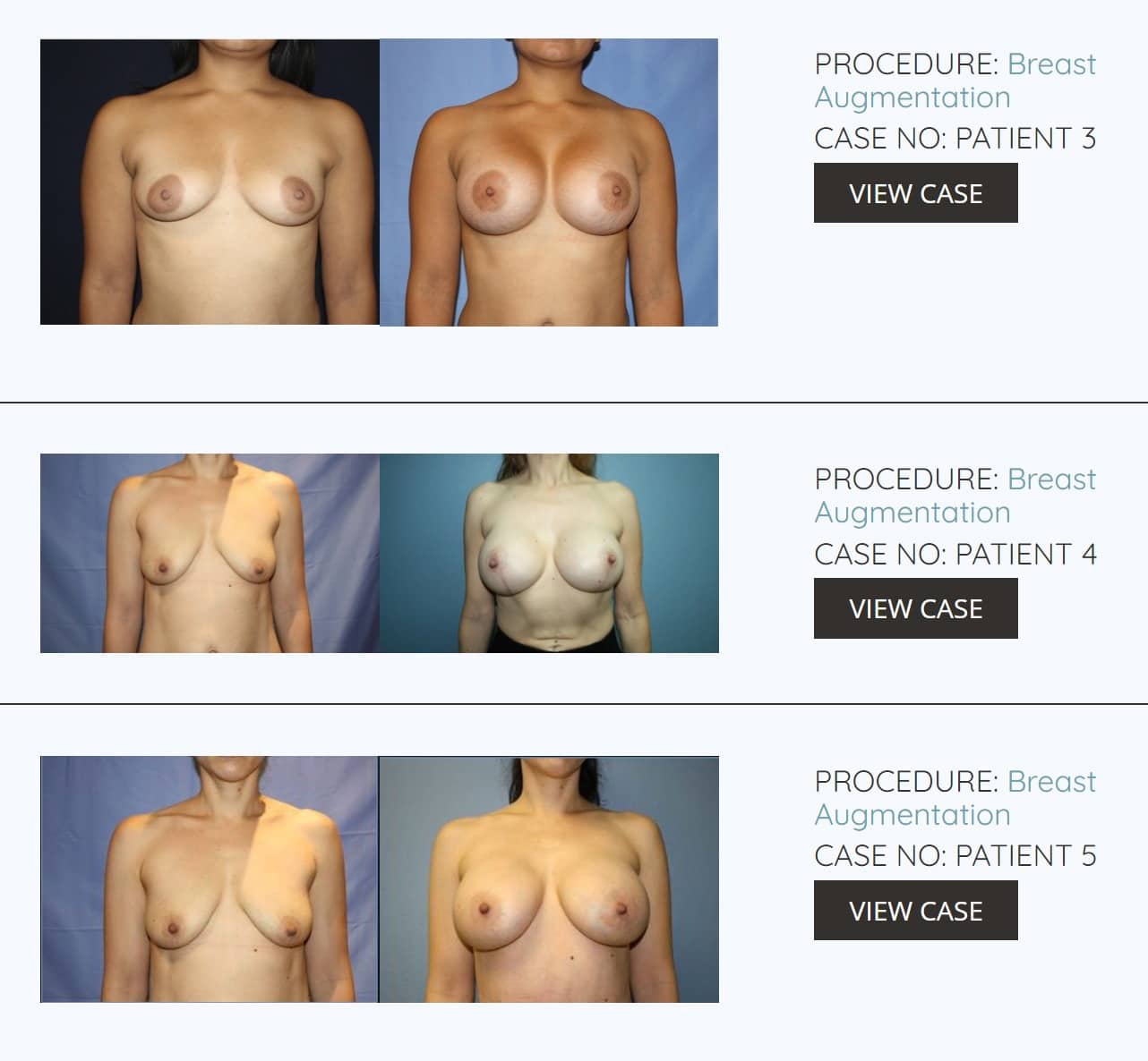 El-Paso-Plastic-Surgeon-Dr-Marco-Gonzales-Breast-Augmentation-before-after-photos
