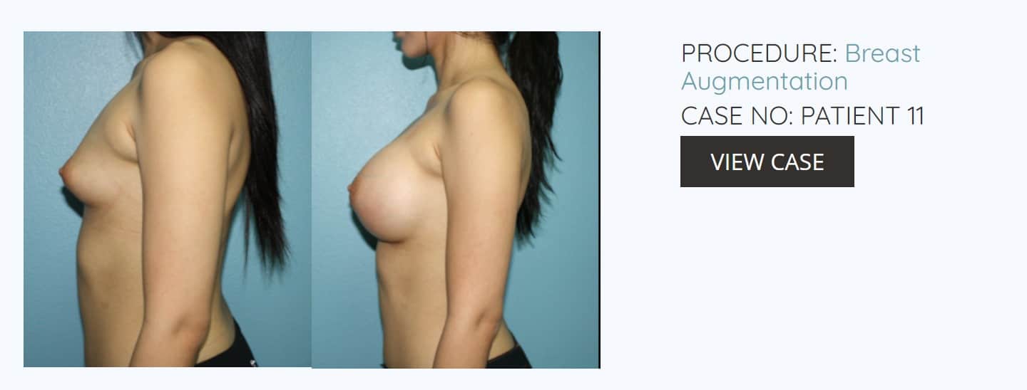 Breast Augmentation, Cosmetic Surgery