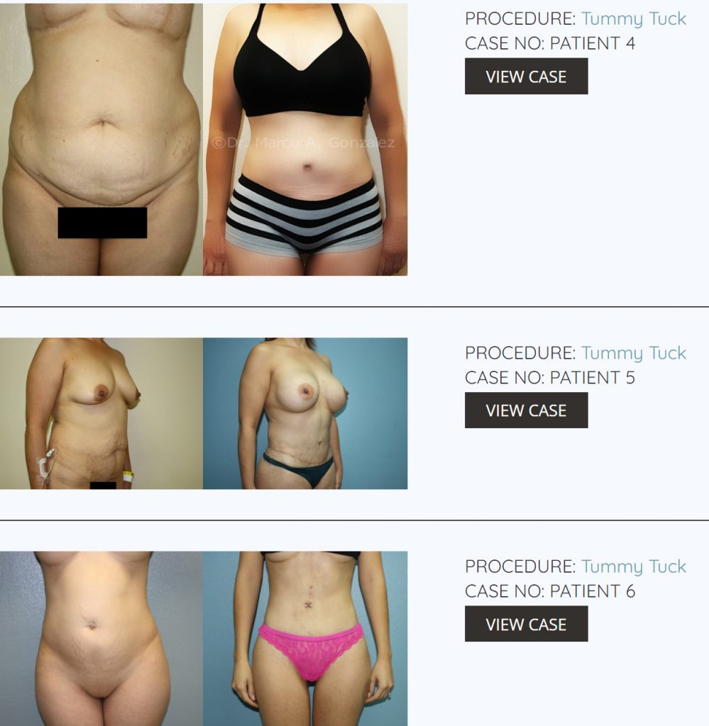 Tummy Tuck Plastic Surgery Before And After Photos 