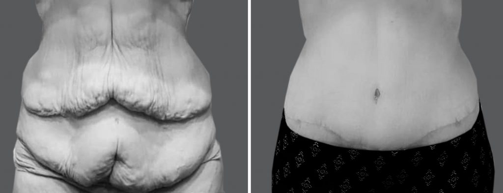 Skin Removal Surgery After Weight Loss