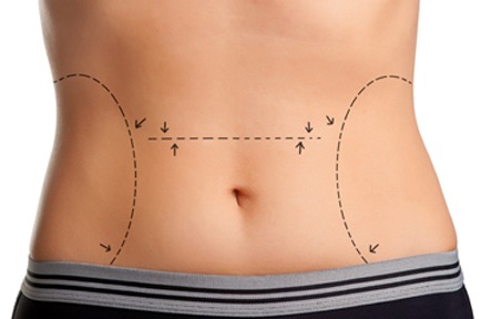 How To Prepare For Tummy Tuck Surgery
