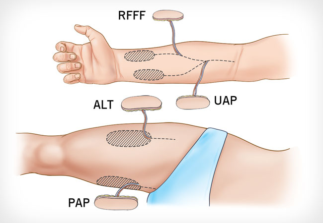 Wound Care: Free Flap Procedure