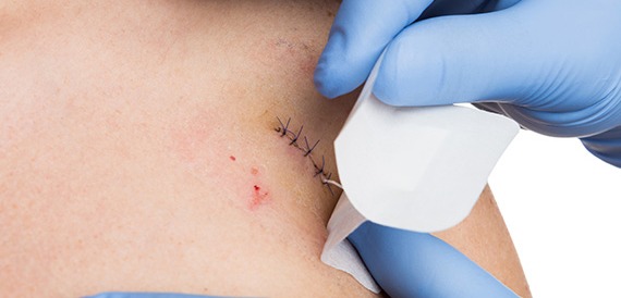 Wound Care: Microsurgery